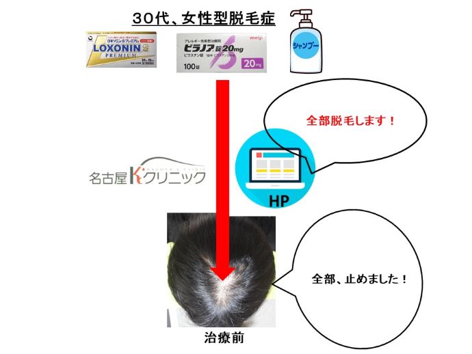 円形脱毛症　病院